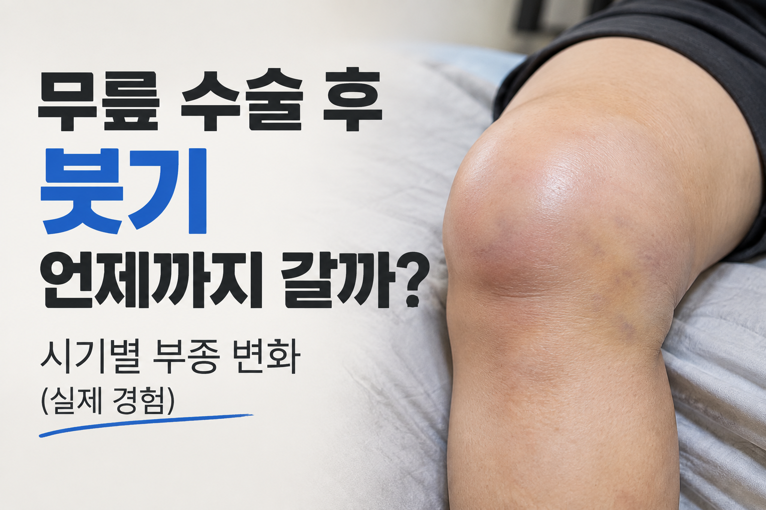 무릎 수술 후 붓기 언제까지 갈까 | 시기별 부종 변화 (실제 경험)